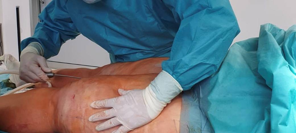 Lipödem: das (un)gesehene Leiden der Frauen