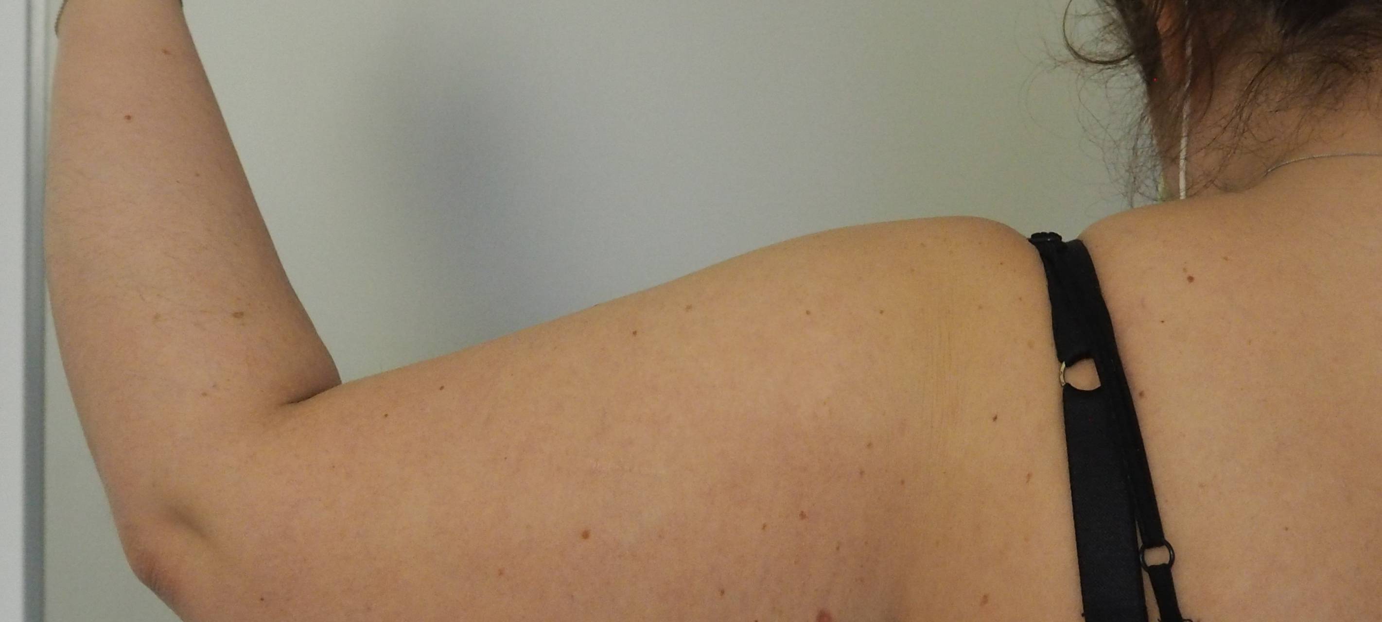 Lipödem: das (un)gesehene Leiden der Frauen