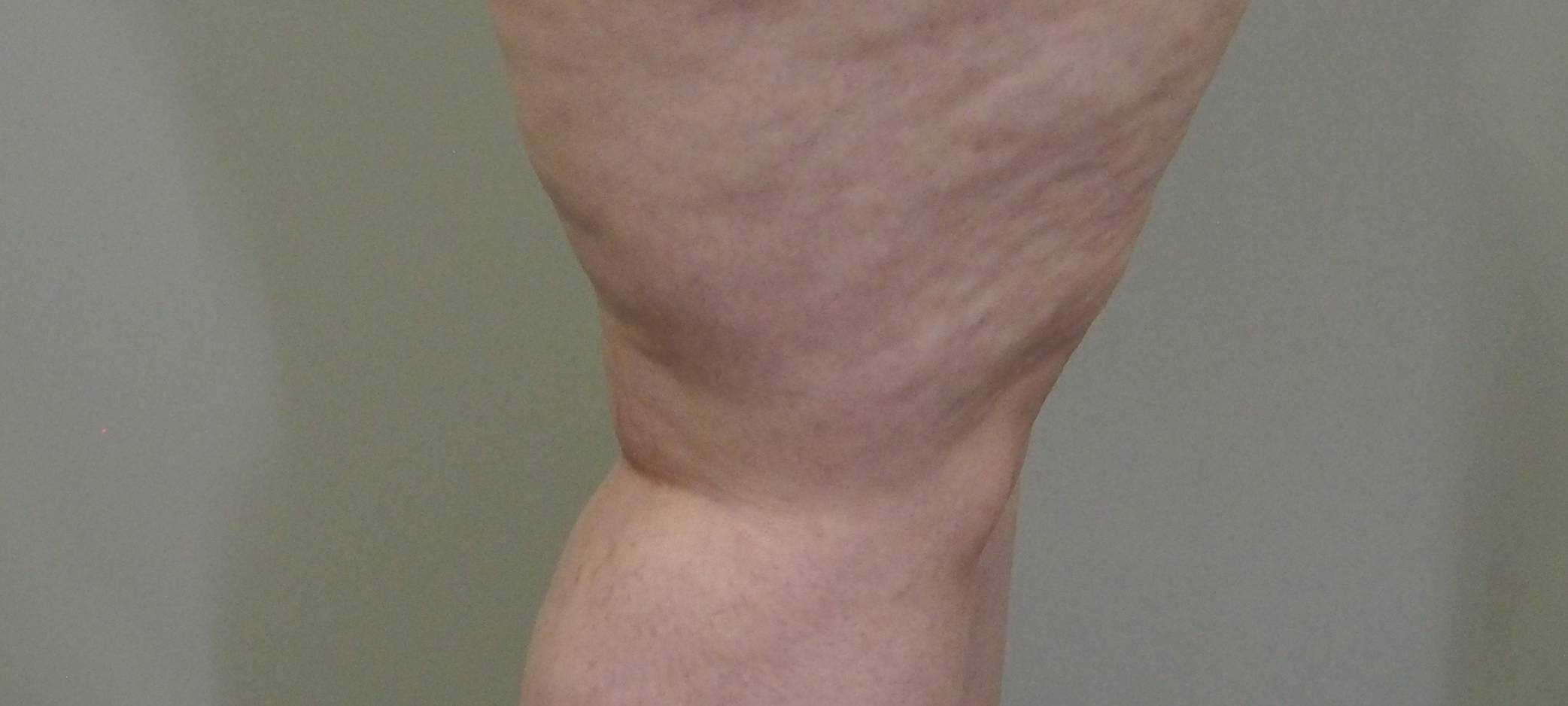 Lipödem: das (un)gesehene Leiden der Frauen