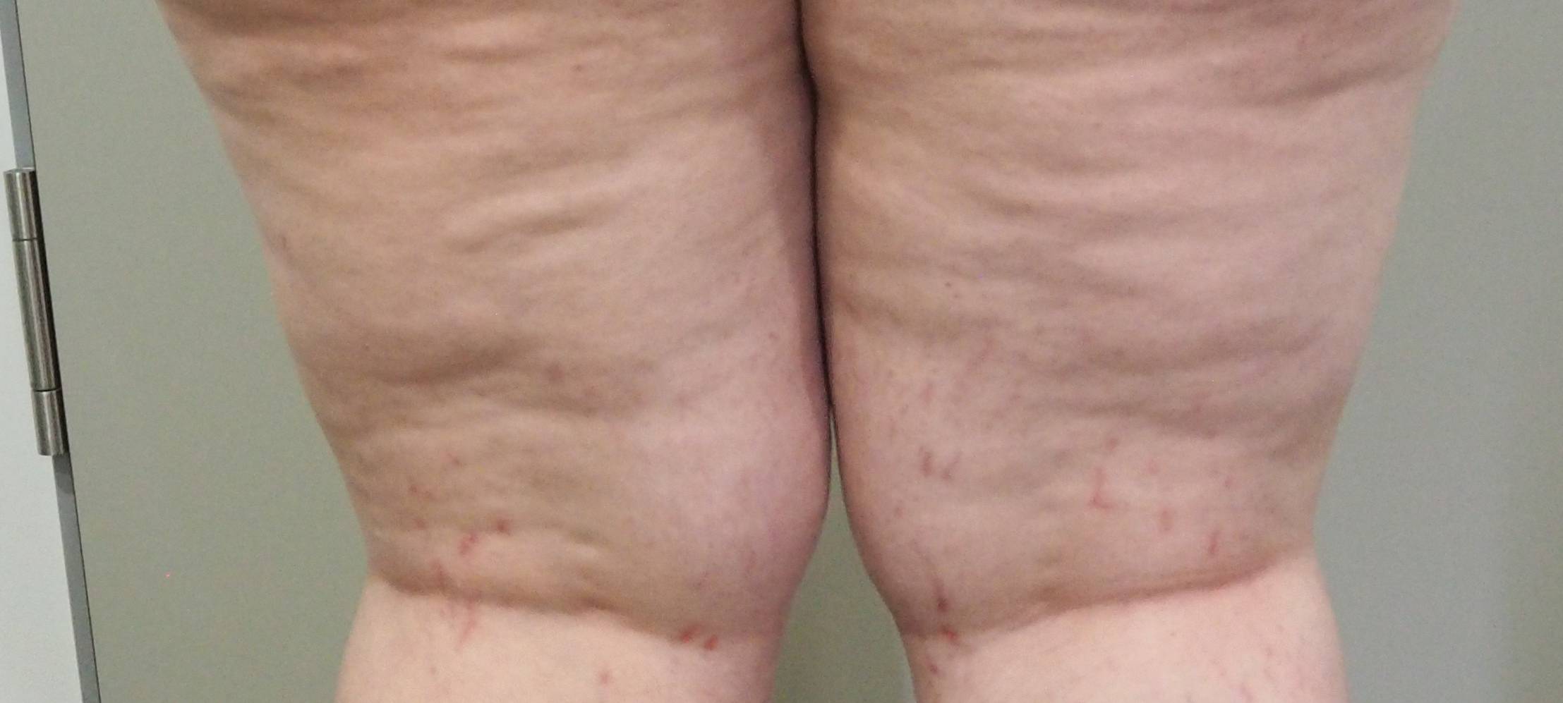 Lipödem: das (un)gesehene Leiden der Frauen