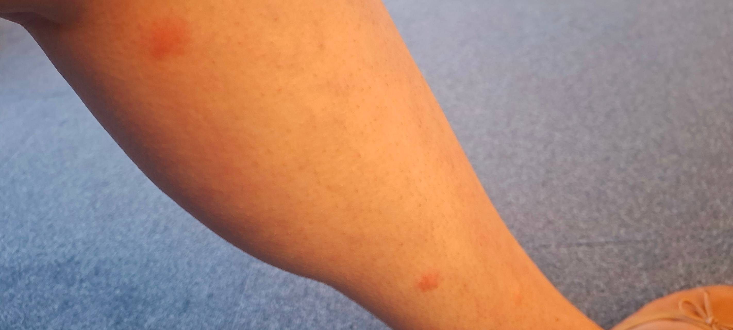 Celinas Mücken-Drama am Morgen